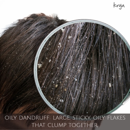 Oily dandruff: caused due to aggravted sebaceous glands or greasy scalp