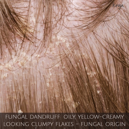 Fungal dandruff: caused by fungal micro organisms - yellow, creamy, large, oily, clumped dandruff