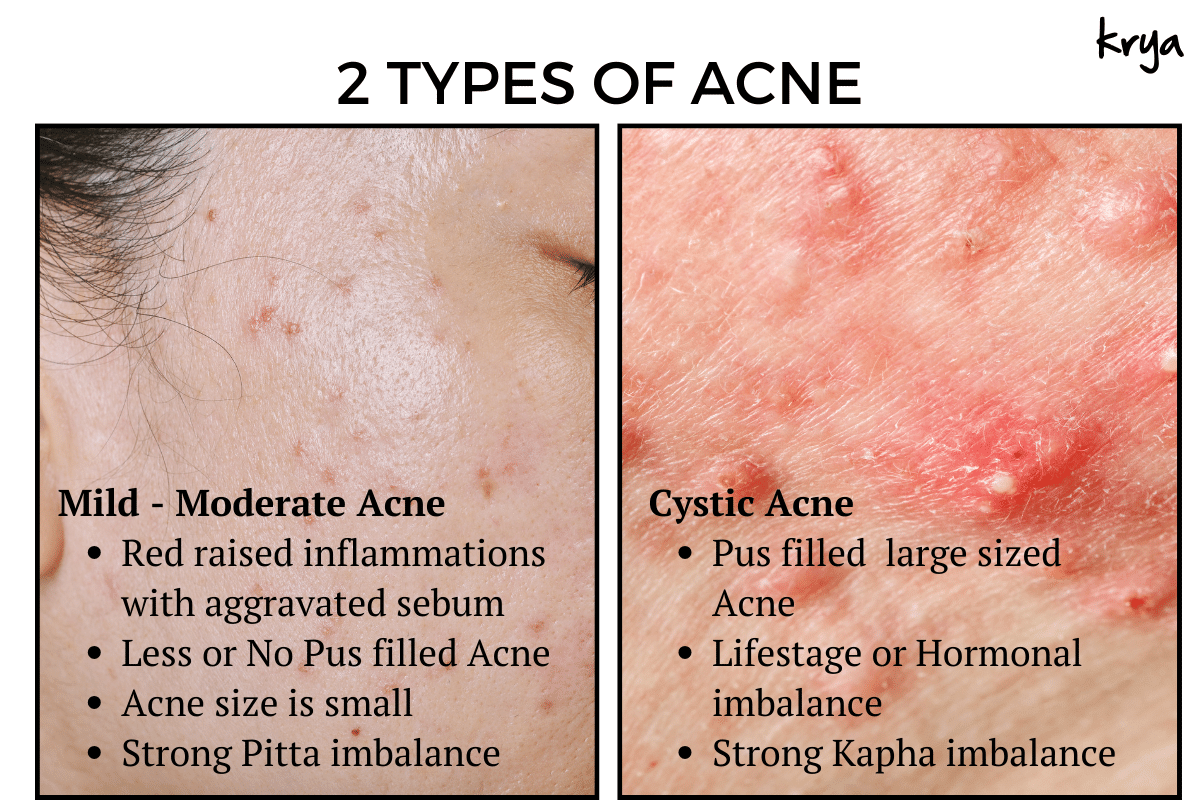 2 types of acne according to ayurveda