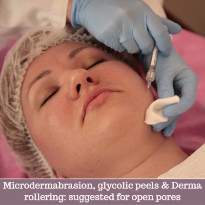 Open pores: dermatologists suggest micridermabrasions and chemical peels as an option to tackle this