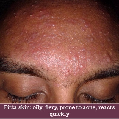 open pores: how does pitta aggravated skin look